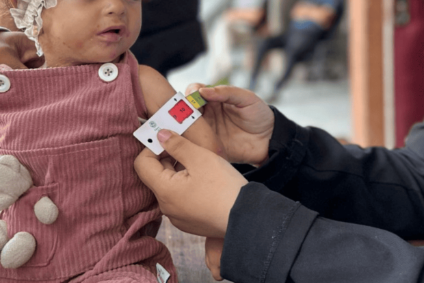 Niña menor de 4 años con signos de desnutrición.