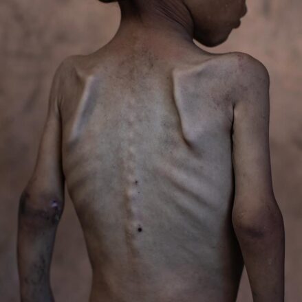 Menor gazatí enfrenta la extrema hambruna que se vive hoy en Gaza