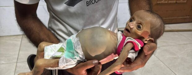 Una pequeña infante muere por la desnutrición severa en la Franja de Gaza