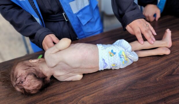 La fotografía muestra a un niño gravemente desnutrido en Gaza, recostado sobre una mesa mientras recibe atención médica.
