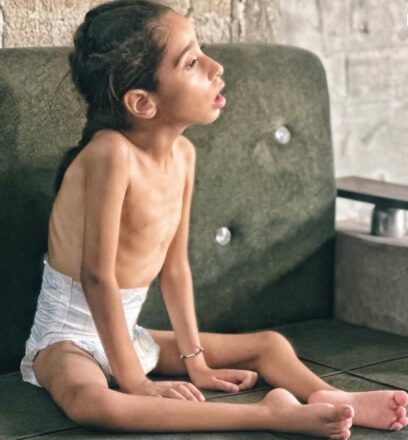 Infante Gazatí en evidentes signos de desnutrición severa