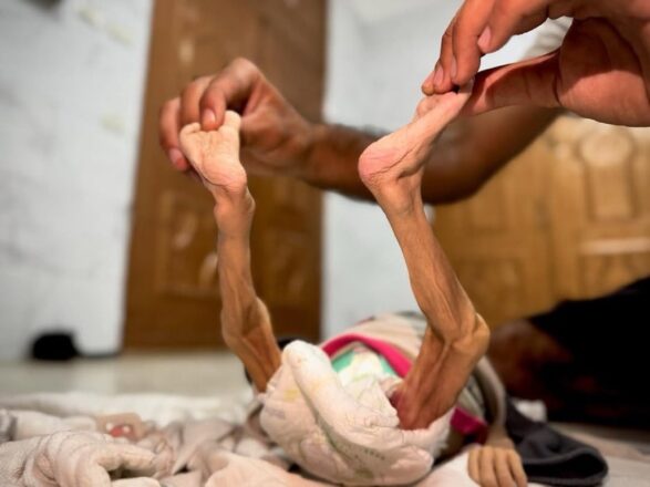Lactante de palestina fallecida por la hambruna
